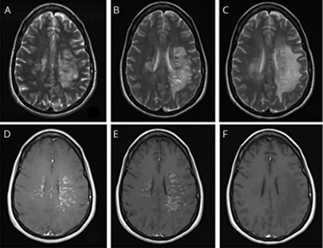 Brain vessel damage due to COVID-19