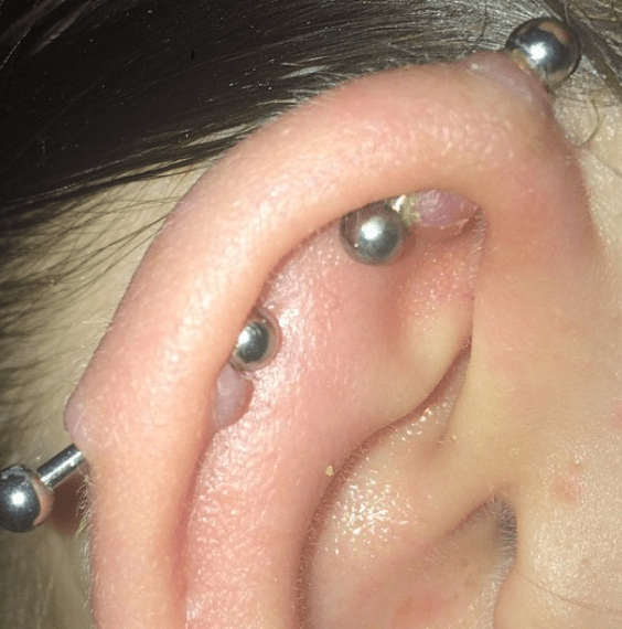 Woman with two infected barbell earrings in her ear