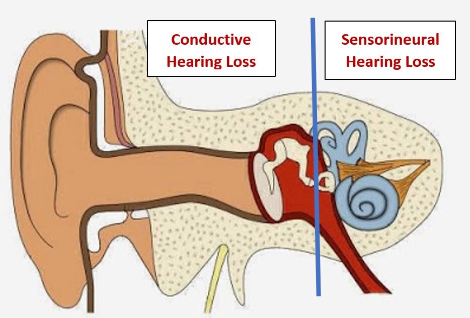 sensorineural hearing loss