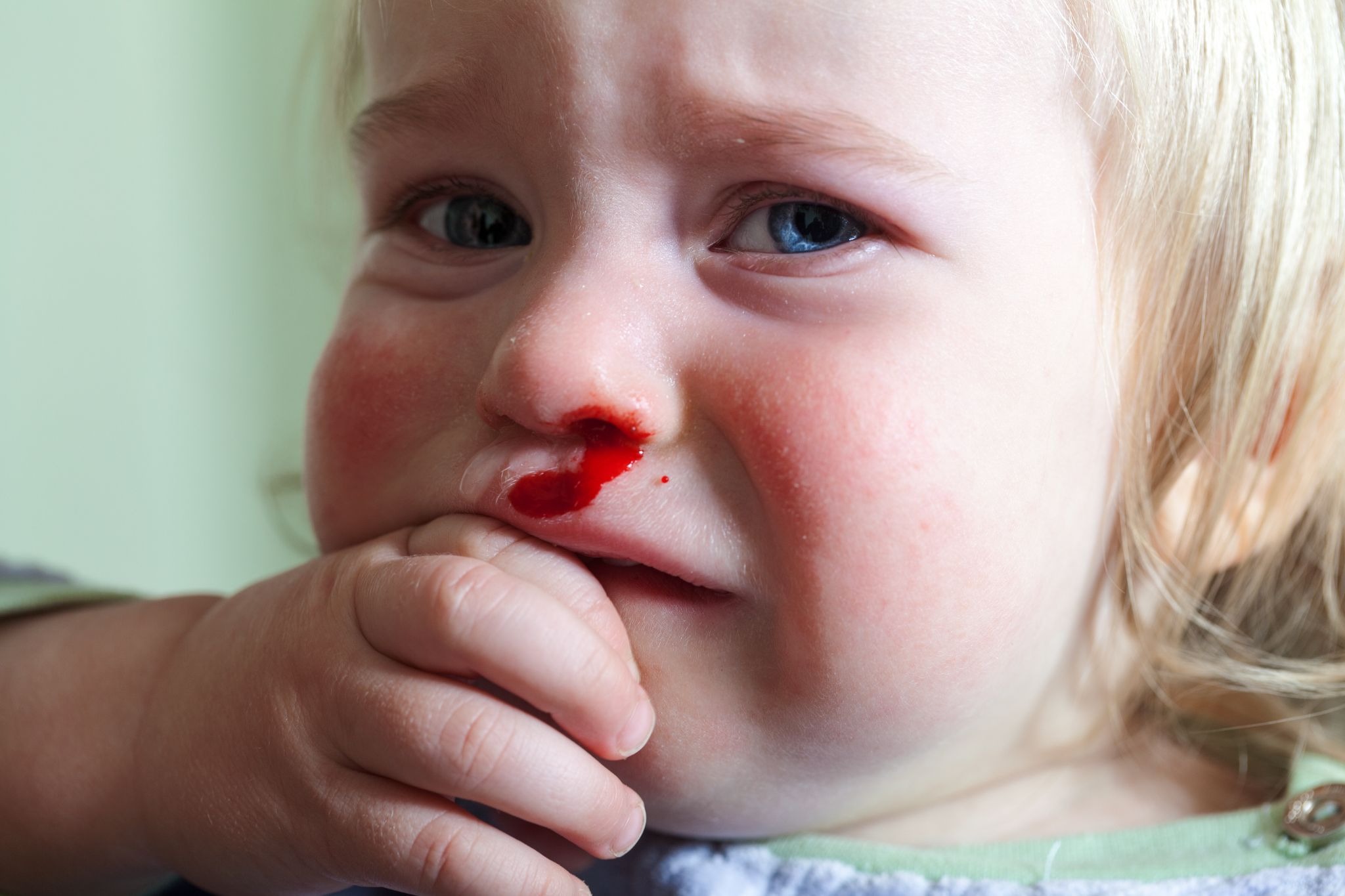 A young child with blood coming out of her nose