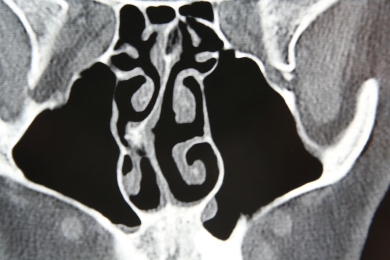 A CT scan of a deviated septum