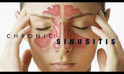 Sinusitis