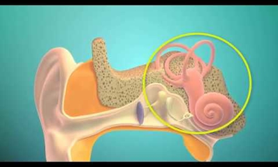 Cochlear Implants