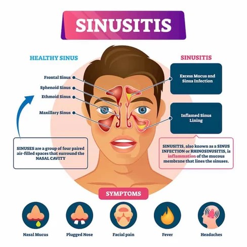 6 Symptoms of Sinusitits