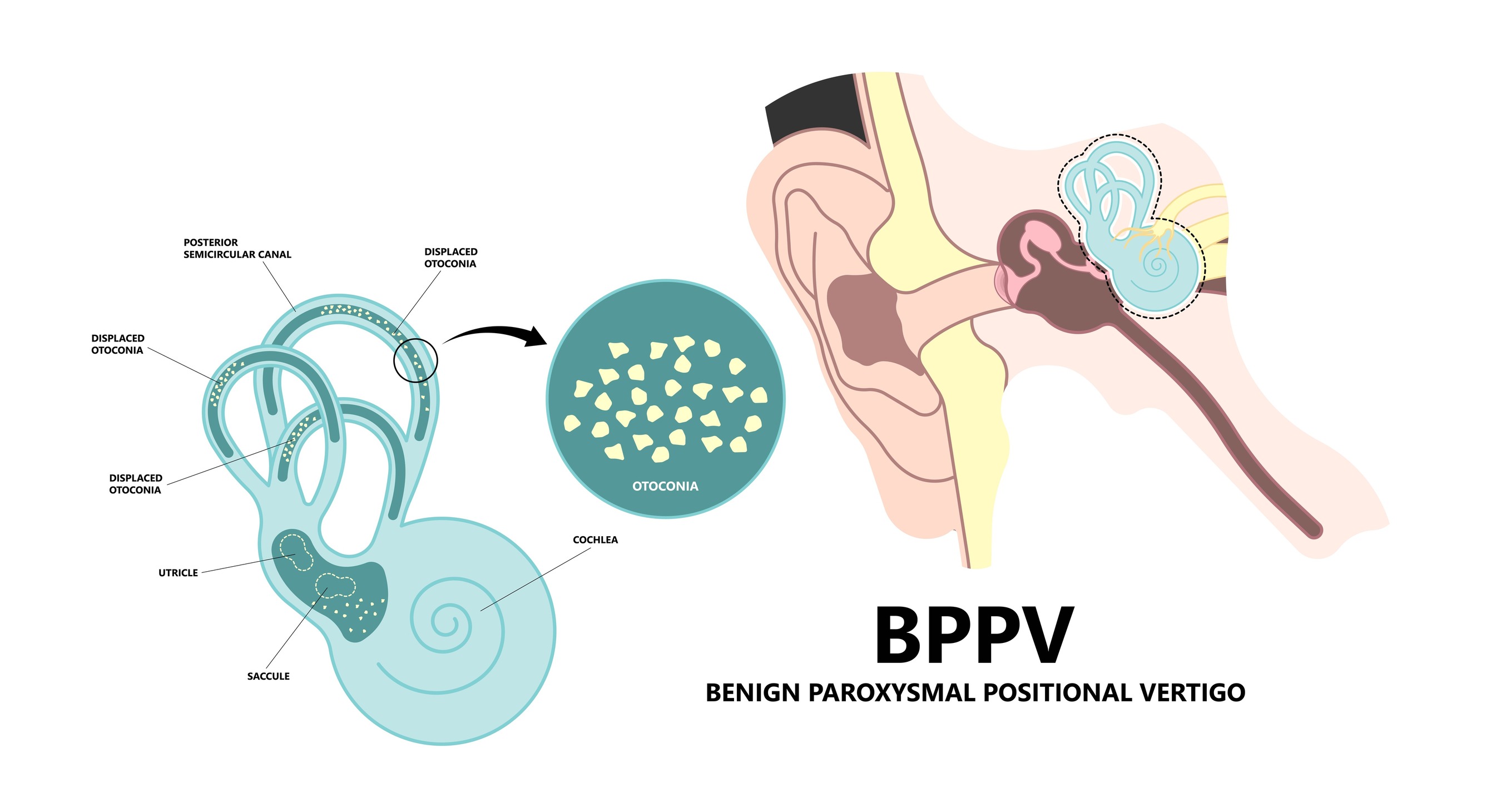 Paroxysmal positional vertigo illustration