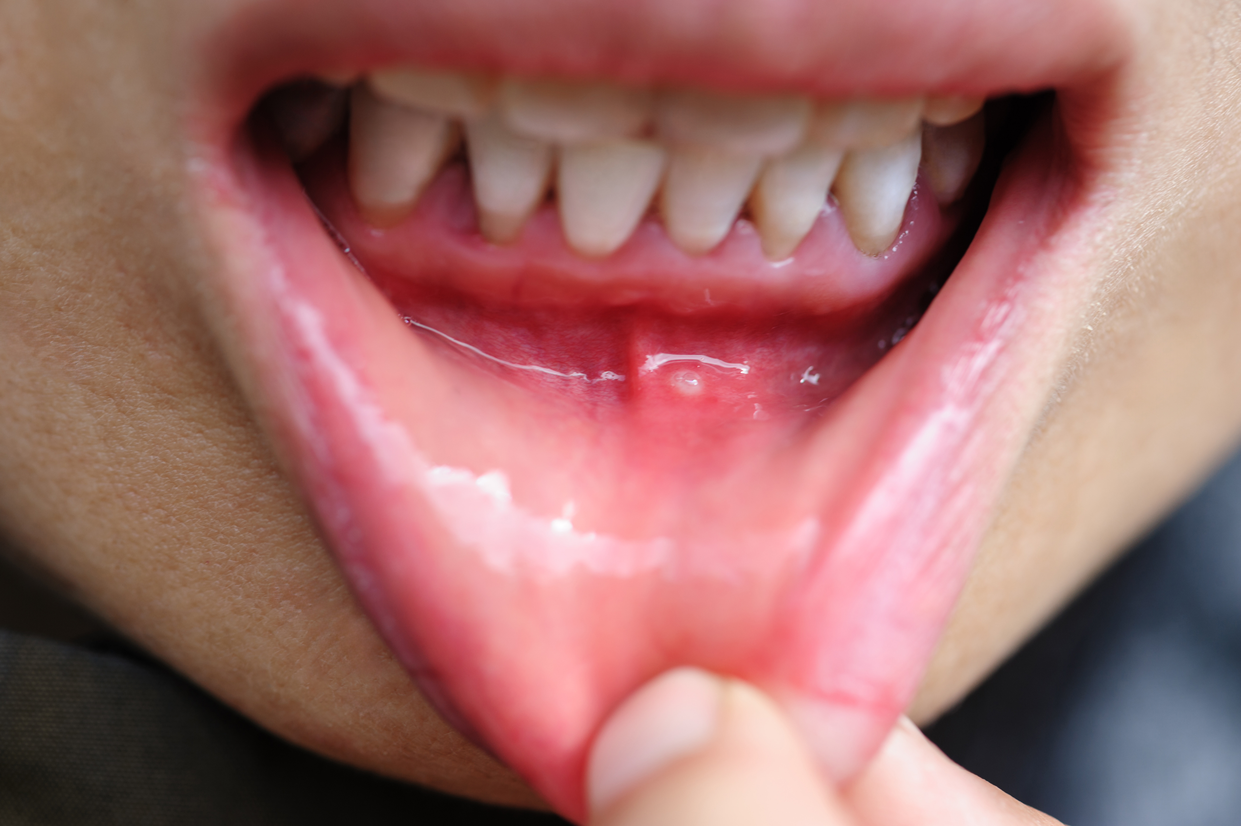 Canker sore in someone's mouth