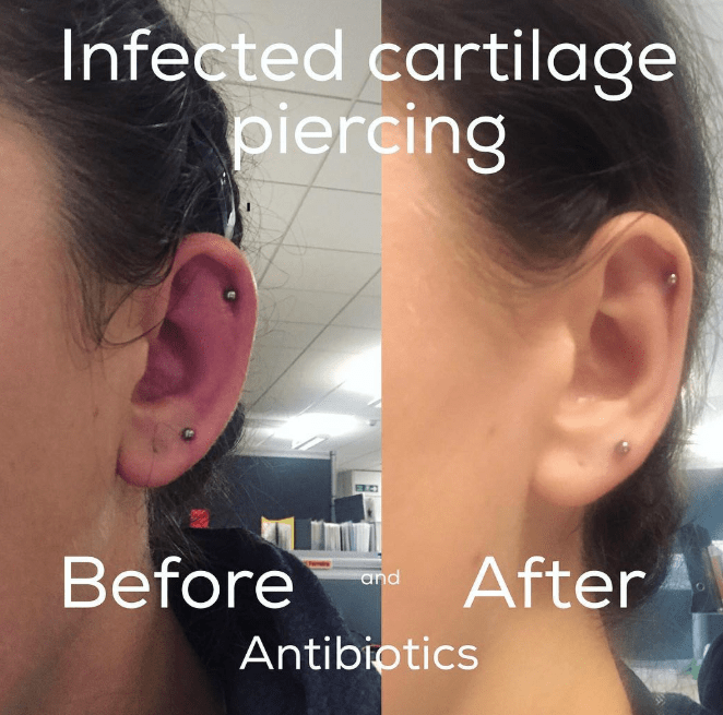 Cartilage Piercing Comparison: One Infected and One Healthy 