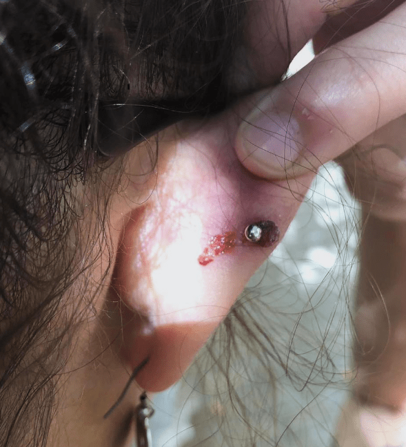 Close Up of Severe Ear Piercing Infection